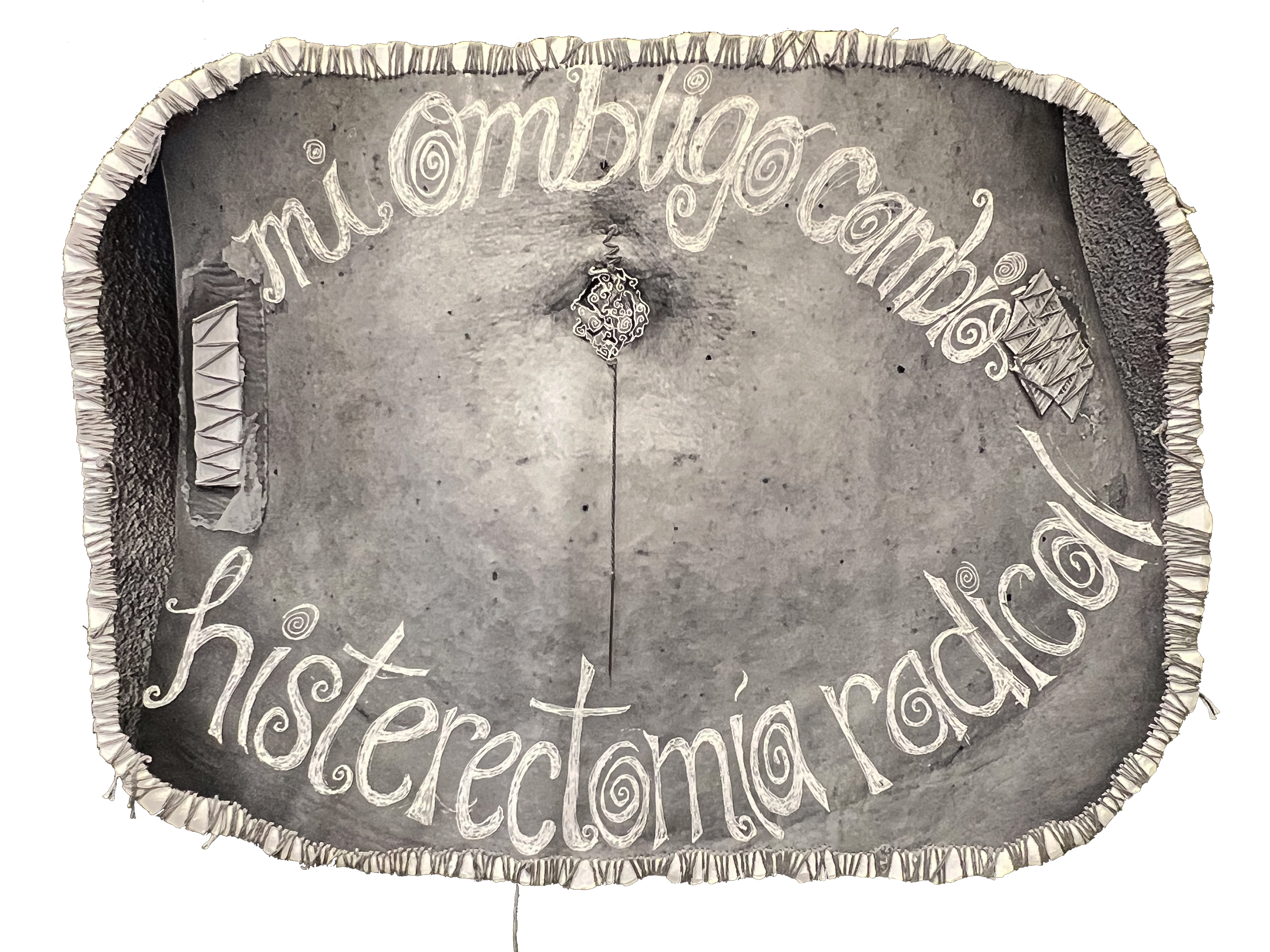 Mi Ombligo cambió - Histerectomía Radical / My navel changed - Radical Hysterectomy