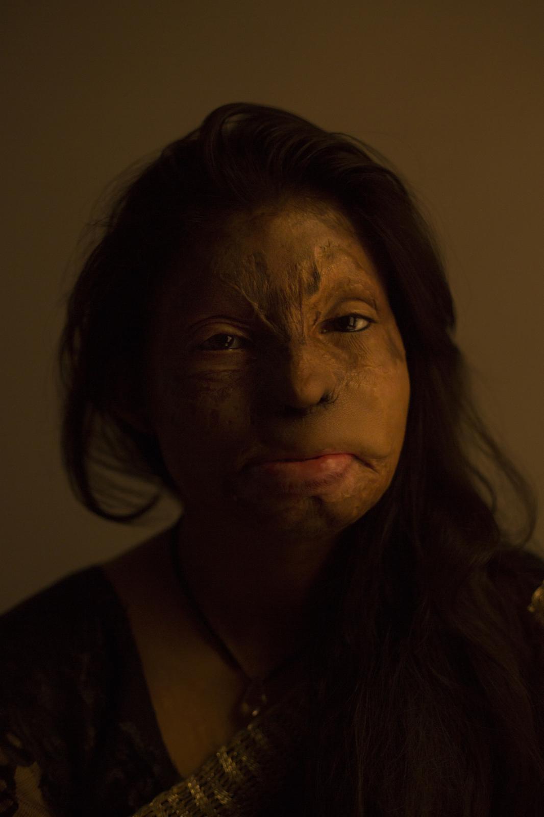The Revived - In 2008 Rupa’s drunk step mother poured acid on her...