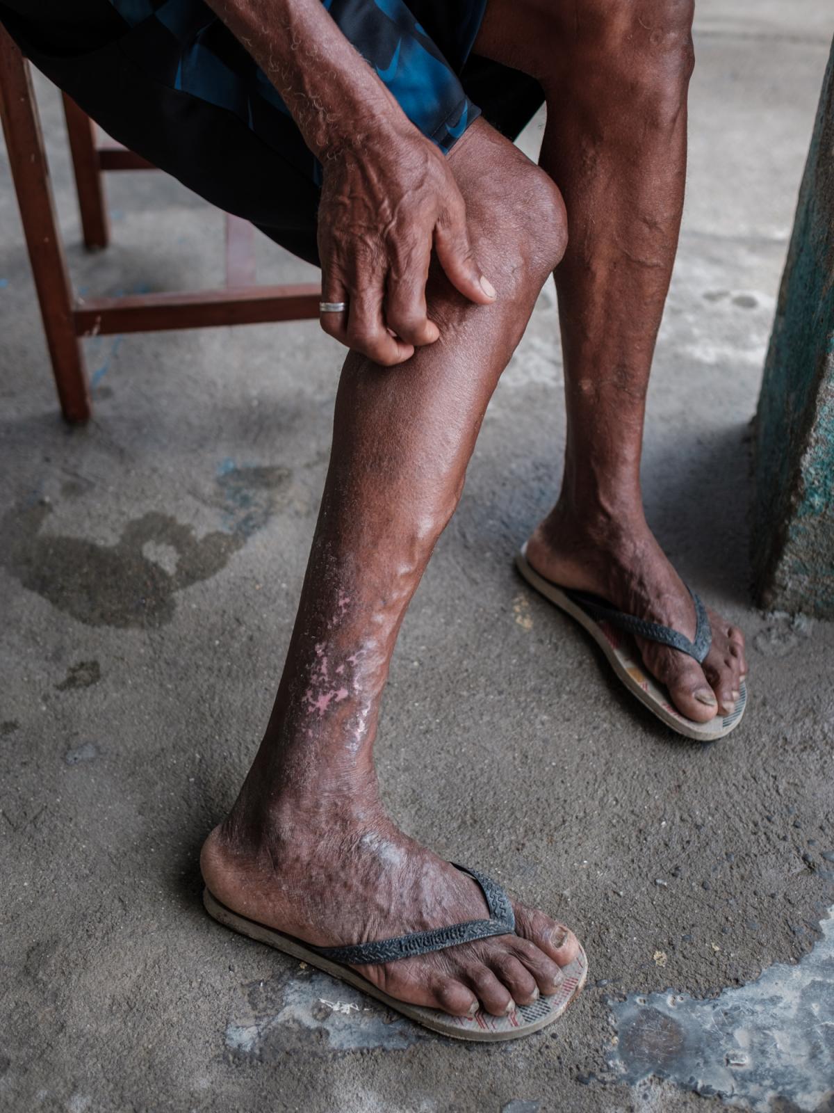 A fisherman shows the scars on his legs thought to be a result of repeated exposure to toxic...