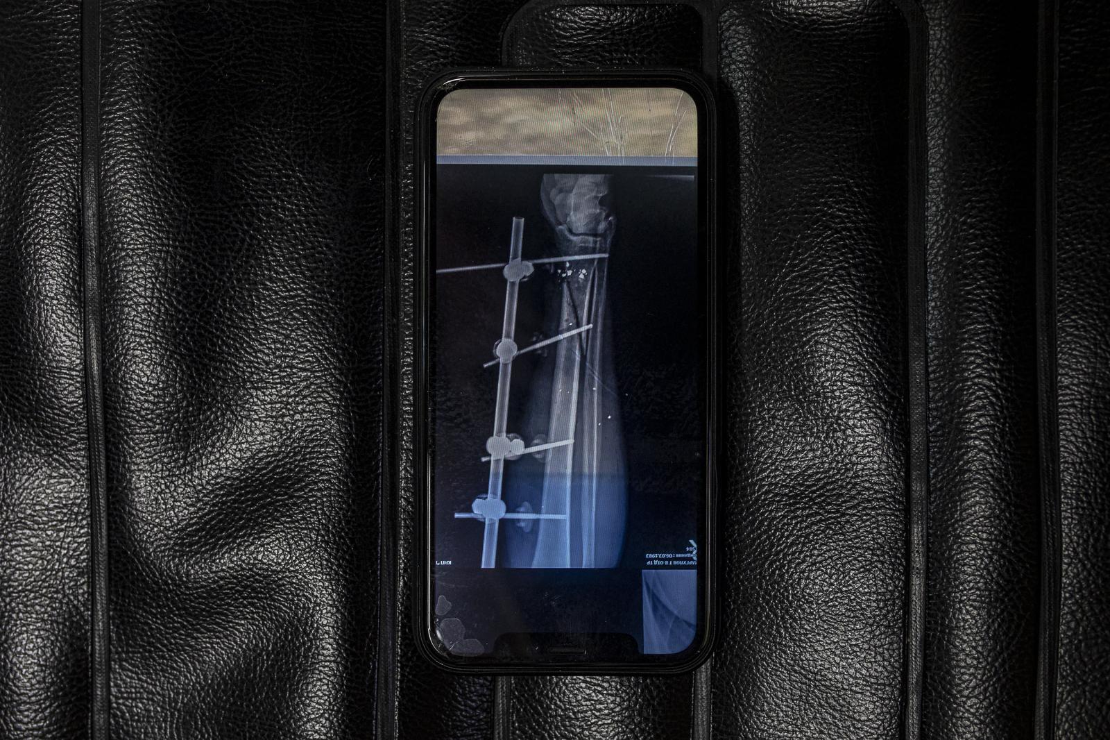 Walking wounded: a journey of recovery and hope - KYIV OBLAST, UKRAINE - JULY 21: Bone x-ray of a soldier...