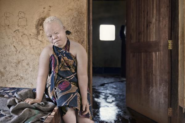 Albino (for editorial)