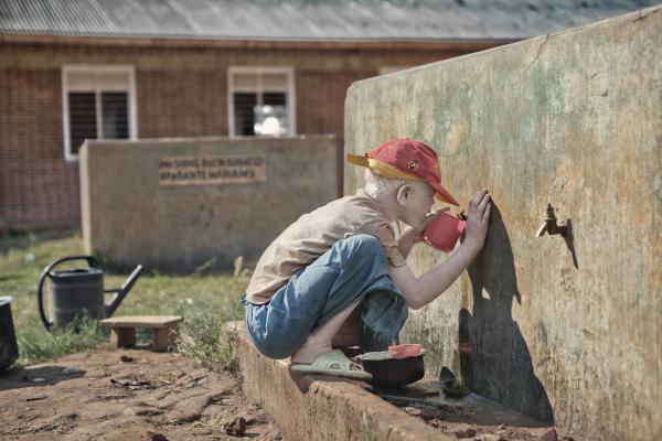 Albino (for editorial) - TANZANIA