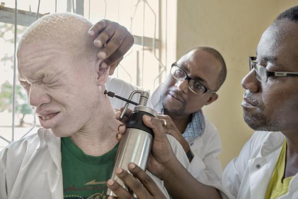Albino (for editorial) - TANZANIA