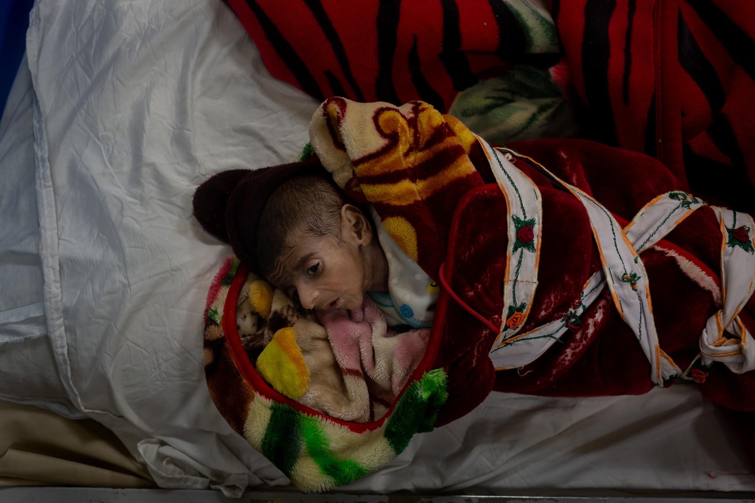 One-year-old Mohamed in the malnutrition ward of the Indira Ghandi Hospital in Kabul.
