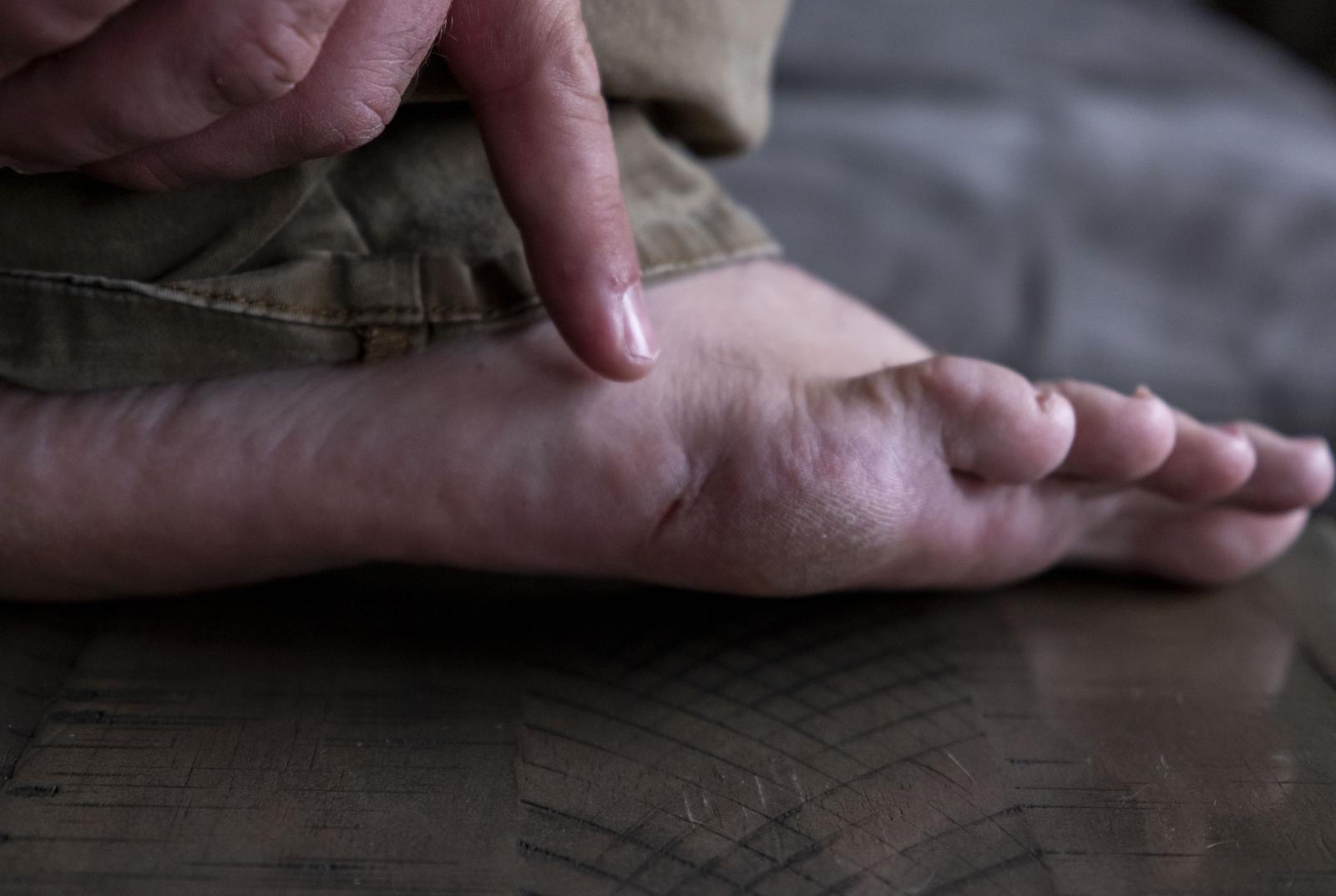 35 years after the Cleveland Elementary School Shooting - Rob Young, a Cleveland Elementary School shooting survivor, shows an exit wound of a bullet on...