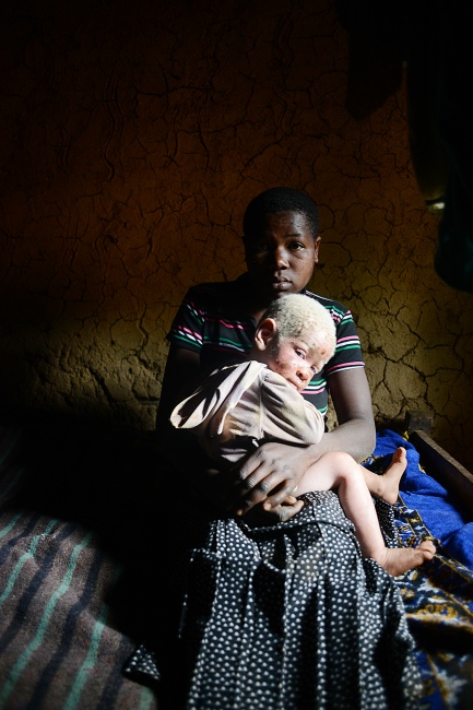 Albinism: Uganda - ...