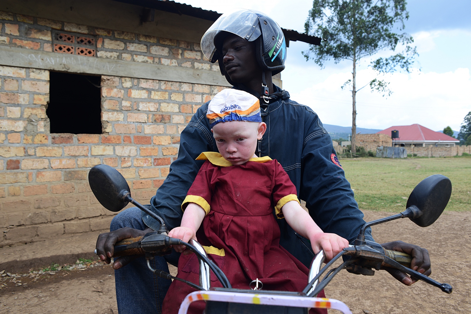 Living with albinism: Uganda
