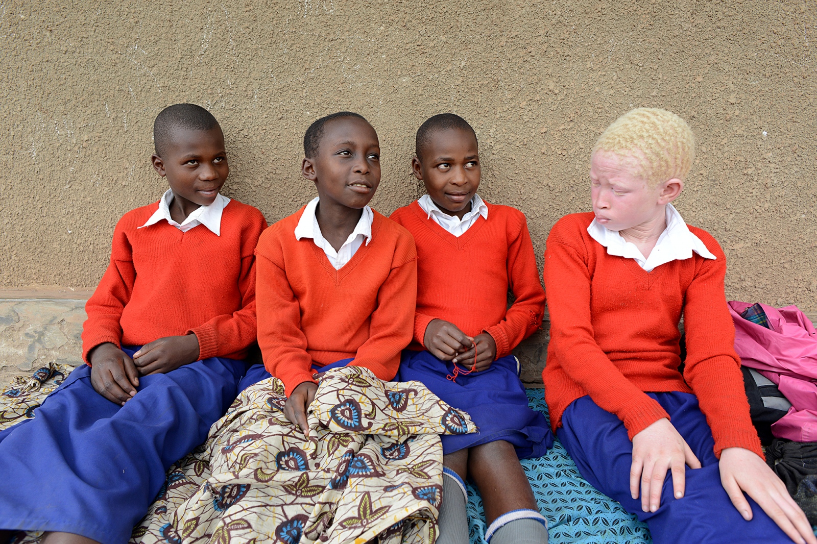 Living with albinism: Uganda