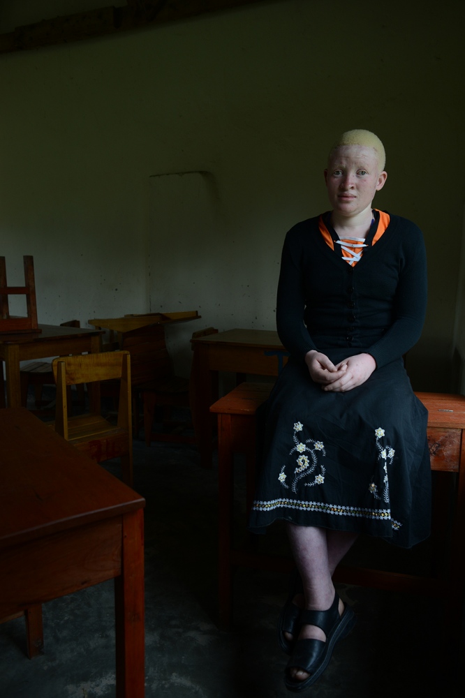 Albinism: Uganda