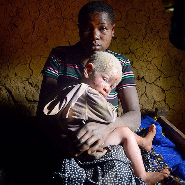 New Work : Ugandans with Albinism on website