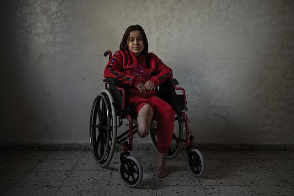 Gaza's Injured Struggle To Recover Six Months After Ceasefire - GAZA CITY, GAZA - NOVEMBER 25: Farah Isleem, 11, poses for a photo in her house in the Sabra...