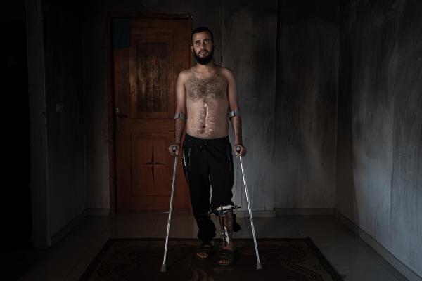 Gaza's Injured Struggle To Recover Six Months After Ceasefire - GAZA CITY, GAZA - NOVEMBER 25: Sultan Al-Masri, 22, poses for a photo in his house in the town of...