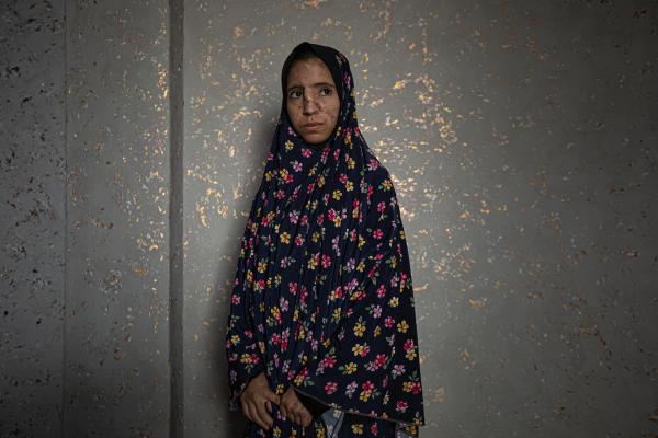 Gaza's Injured Struggle To Recover Six Months After Ceasefire - GAZA CITY, GAZA - NOVEMBER 30: Esraa Abu Fares, 19, poses for a photo in her house in the Bedouin...