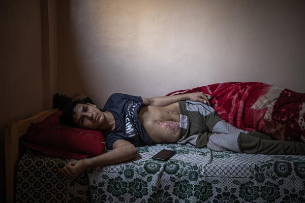 Gaza's Injured Struggle To Recover Six Months After Ceasefire - GAZA CITY, GAZA - DECEMBER 04: Mahmoud Naim, 17, poses for a photo in his house in the Zeitoun...