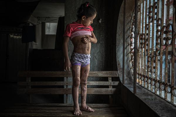 Gaza's Injured Struggle To Recover Six Months After Ceasefire - GAZA CITY, GAZA - DECEMBER 04: Farah Al-Bahtiti, 5, poses for a photo in her house in the Zeitoun...