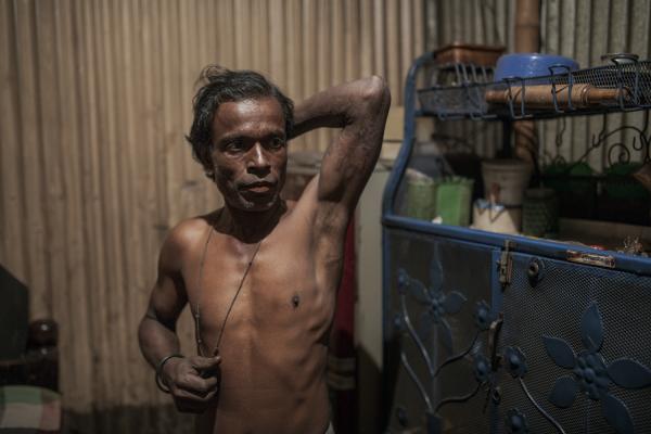 Dangerous job of recycling - Alom shows the burns that an accident caused on his body. He is a laborer who cleans plastic in...