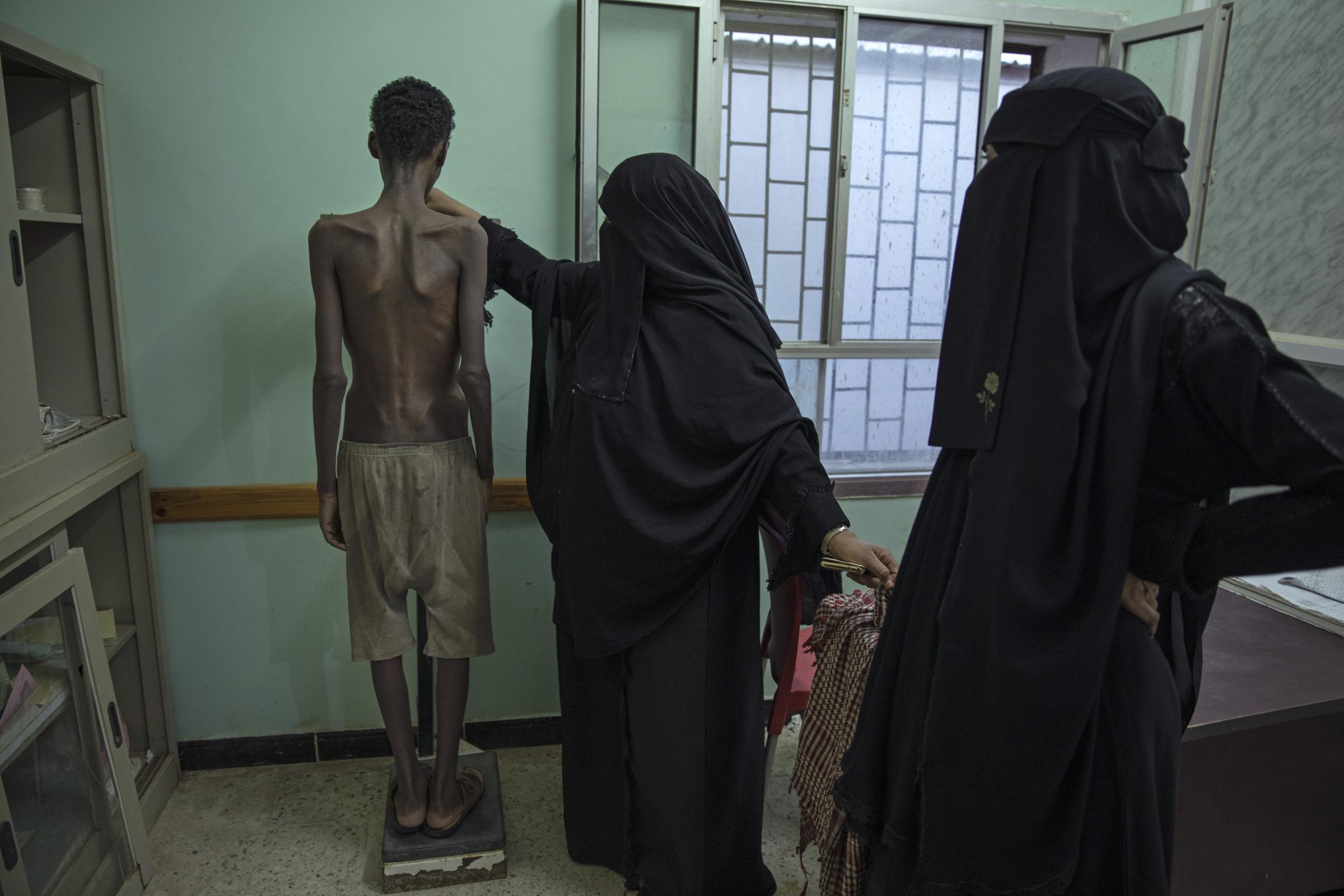  Mohammed Hussein, severely malnourished from imprisonment by smugglers, stands on a scale at the Ras al-Ara Hospital in Lahj, Yemen. He weighs 31 kilograms (68 pounds). Starvation is a punishment used by the traffickers to wear down their victims. 