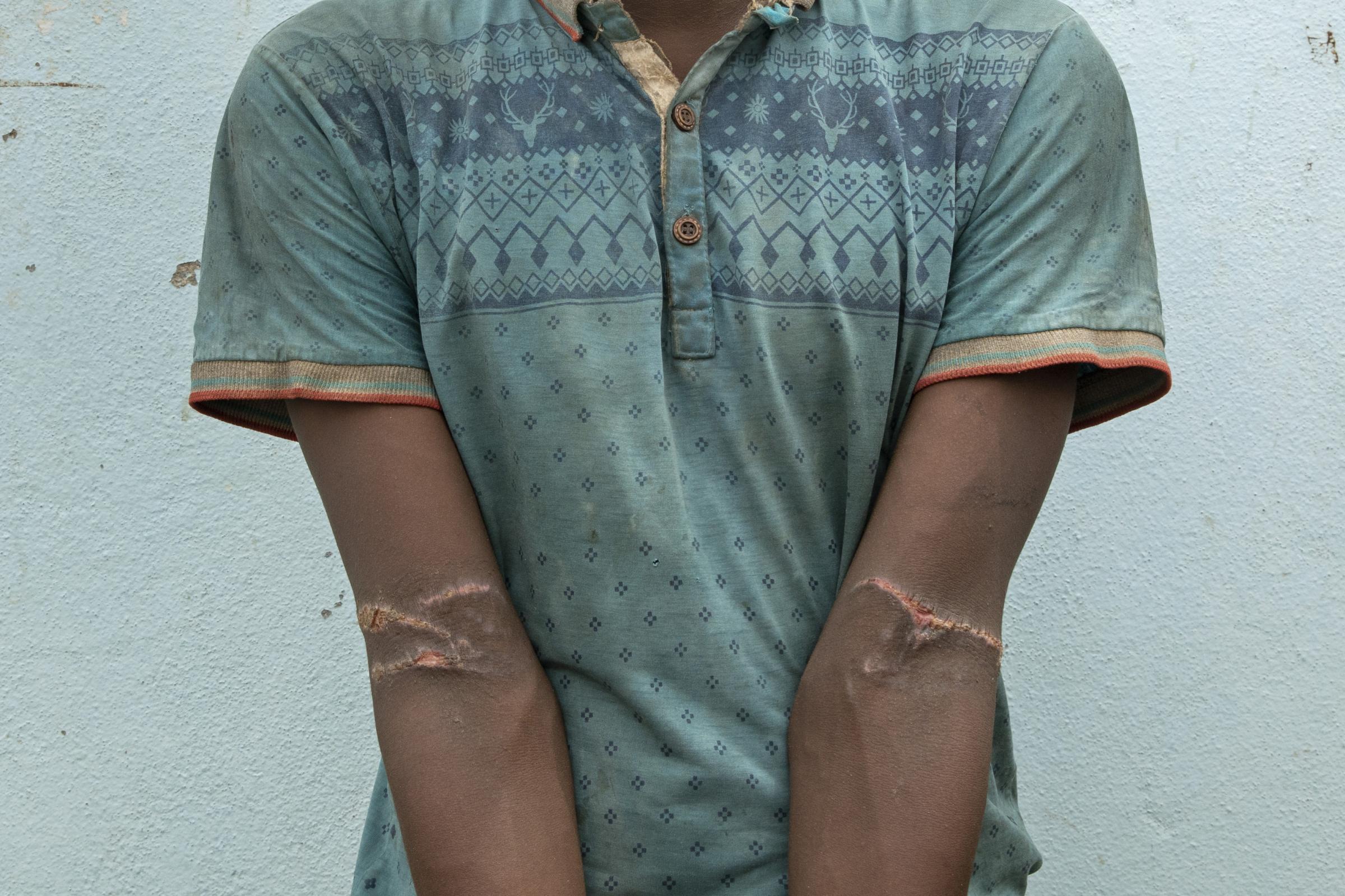  Ibrahim Bakalah Hassan, 24, shows scars from torture in a &quot;hosh&quot; in Lahj, Yemen. He says his arms were tied behind his back, and wants to go back to Ethiopia. 
