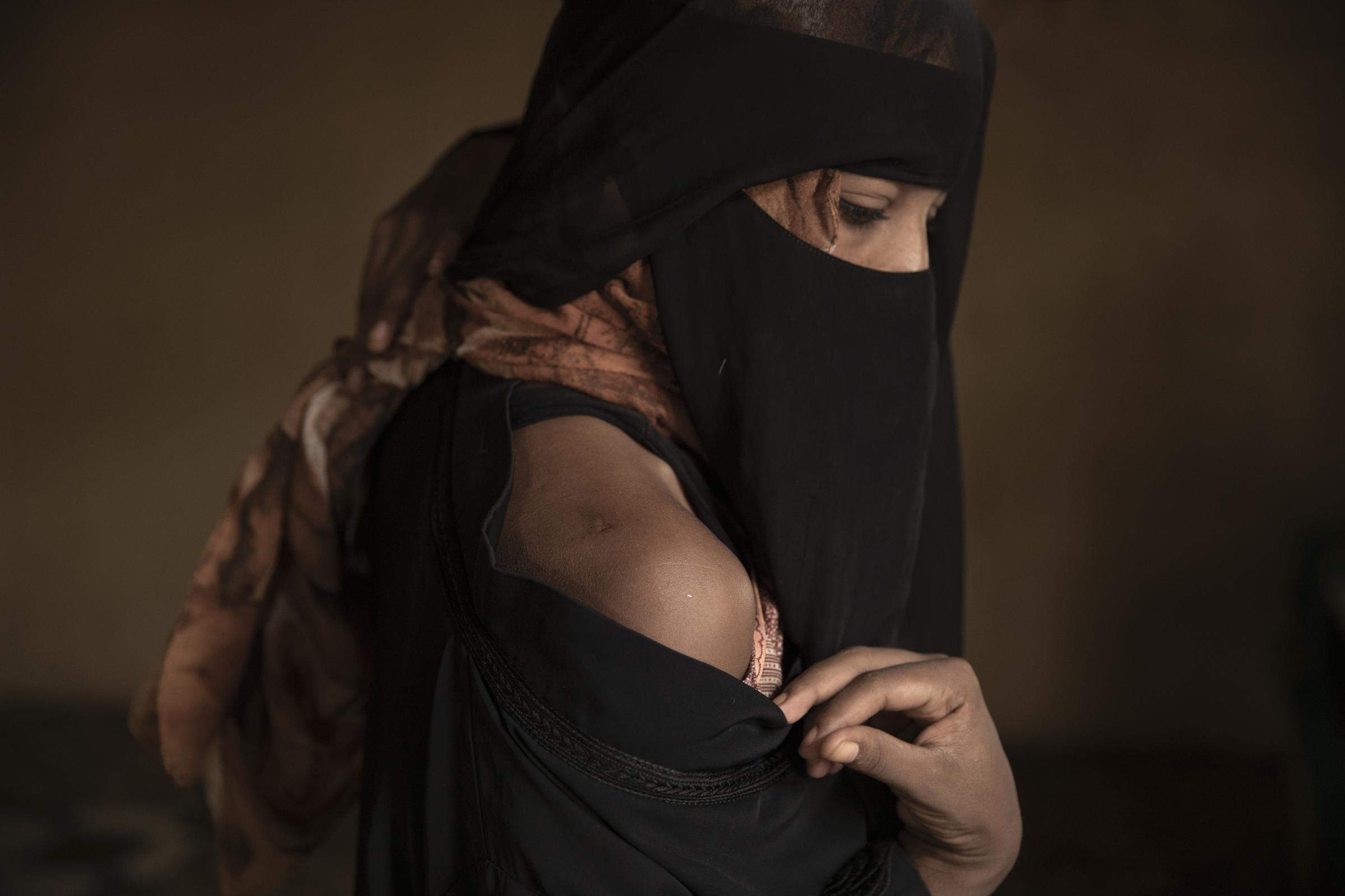  Eman Idrees shows her shoulder with a wound from torture after being held and abused for eight months in a &quot;hosh,&quot; run by an Ethiopian smuggler in Ras al-Ara, Lahj, Yemen. 