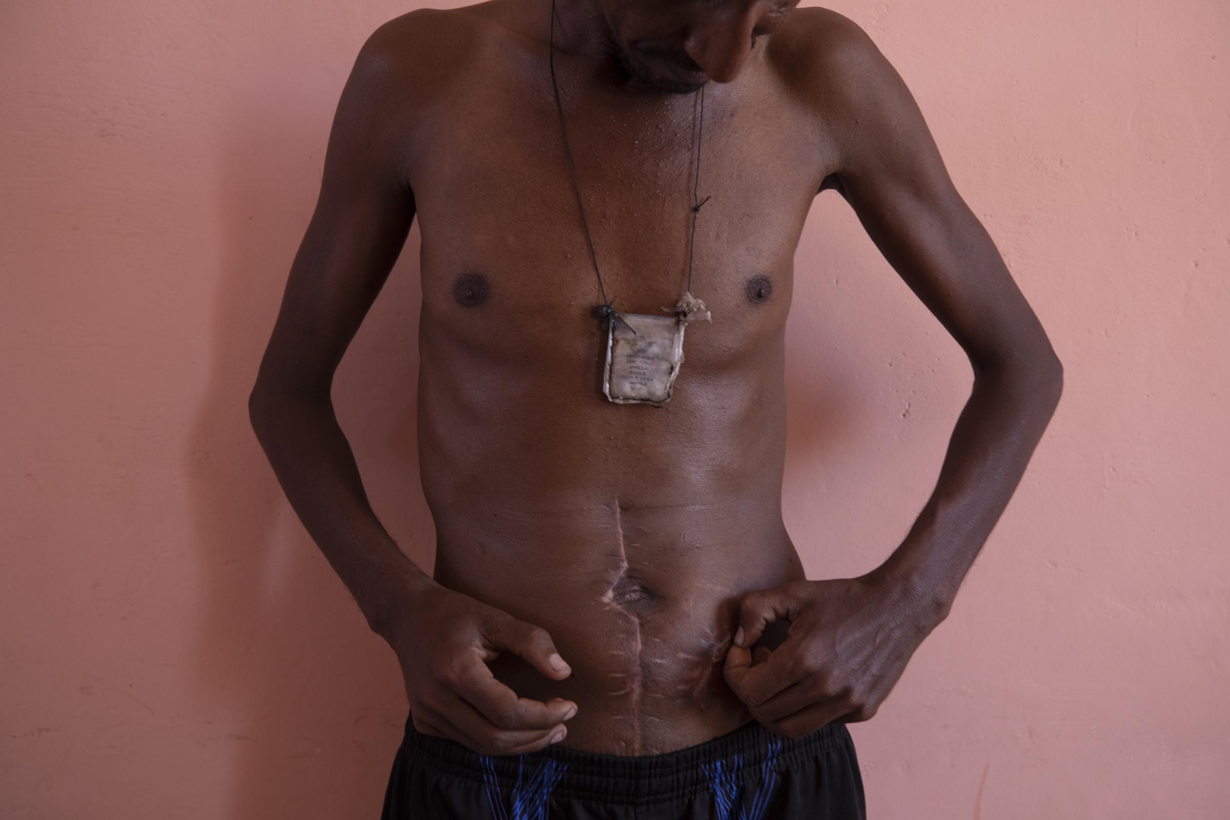 Nega Chekole, 30, from Humera, touches his stitched wound. He says he remembers being shot by militias before the war broke out on Nov. 4. The atrocities have been seared into his skin.