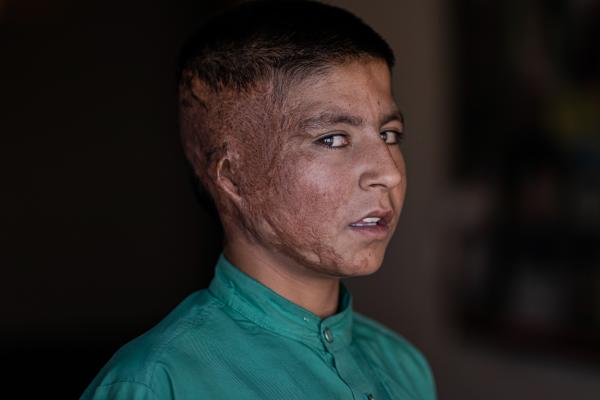 Contrasting Childhoods Joyful Play vs Hardship - The burned face of a child following a suicide attack in Badghis Province.