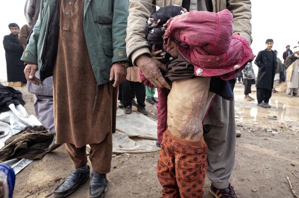 Contrasting Childhoods Joyful Play vs Hardship - The burned torso of an 8-year-old child who survived a suicide attack on the Herat-Kandahar highway.