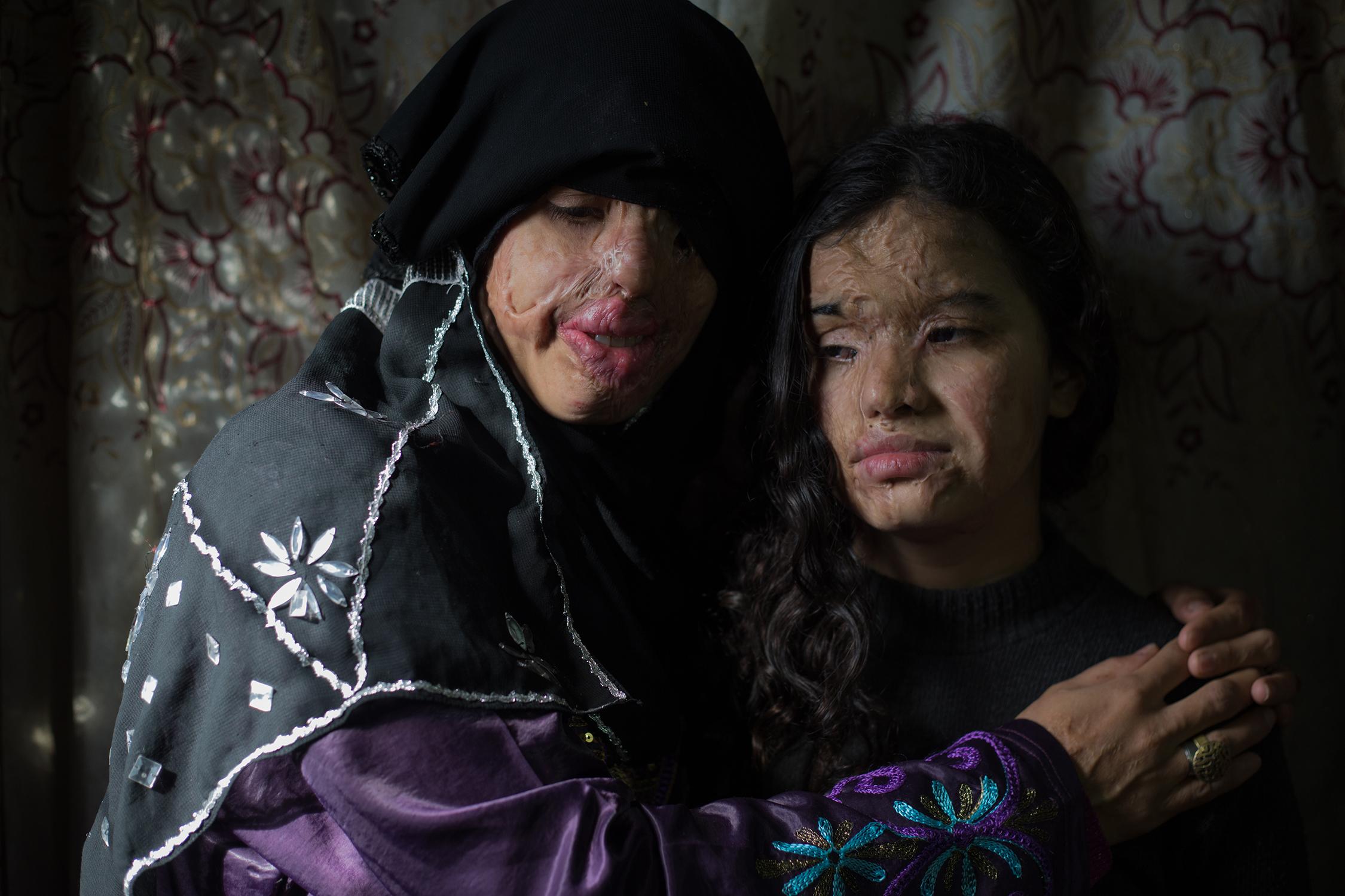 Eman a woman who faced malformation by her husband Eman and her daughter who is 13 years old were attacked with acid after she fill for divorce.