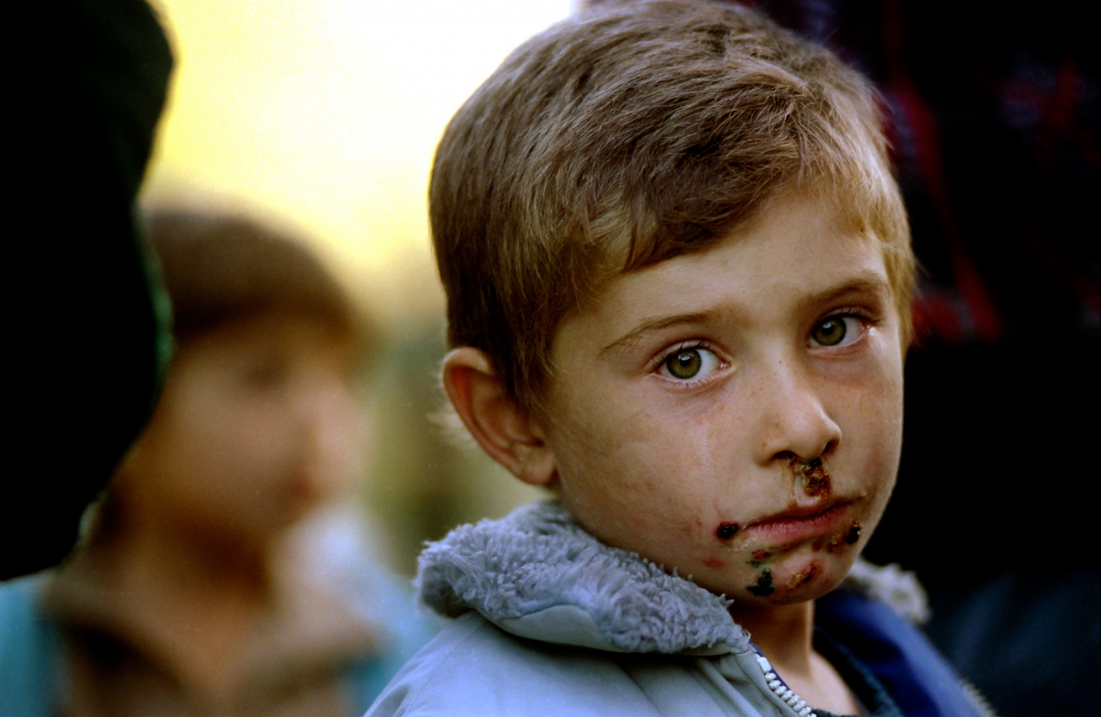 Forgotten Wars - A young boy's face is marked with frostbite after his...