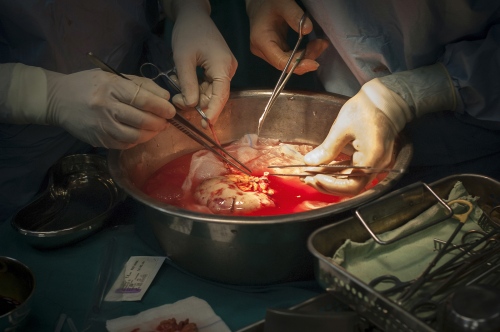 Image from LITI in the Gaza Strip -   Dr Abdul Hammad preparing the removed kidney and making...