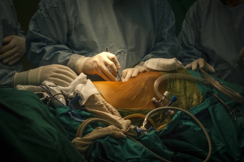   First cut. Dr Sanjay Mehra (dual British/Indian nationality) from the Royal Liverpool University Hospital starts the &#39;Total Retroperitoneoscopic Donor Nephreotomy&#39; procedure to remove a donors kidney at the Al Shifa Hospital, Gaza City.  
