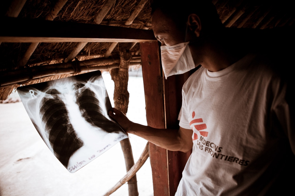 MSF TB Uganda