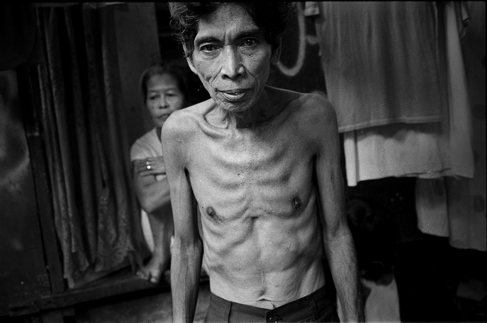 Alberto, a resident of an urban...ng symptoms of Tuberculosis.â€