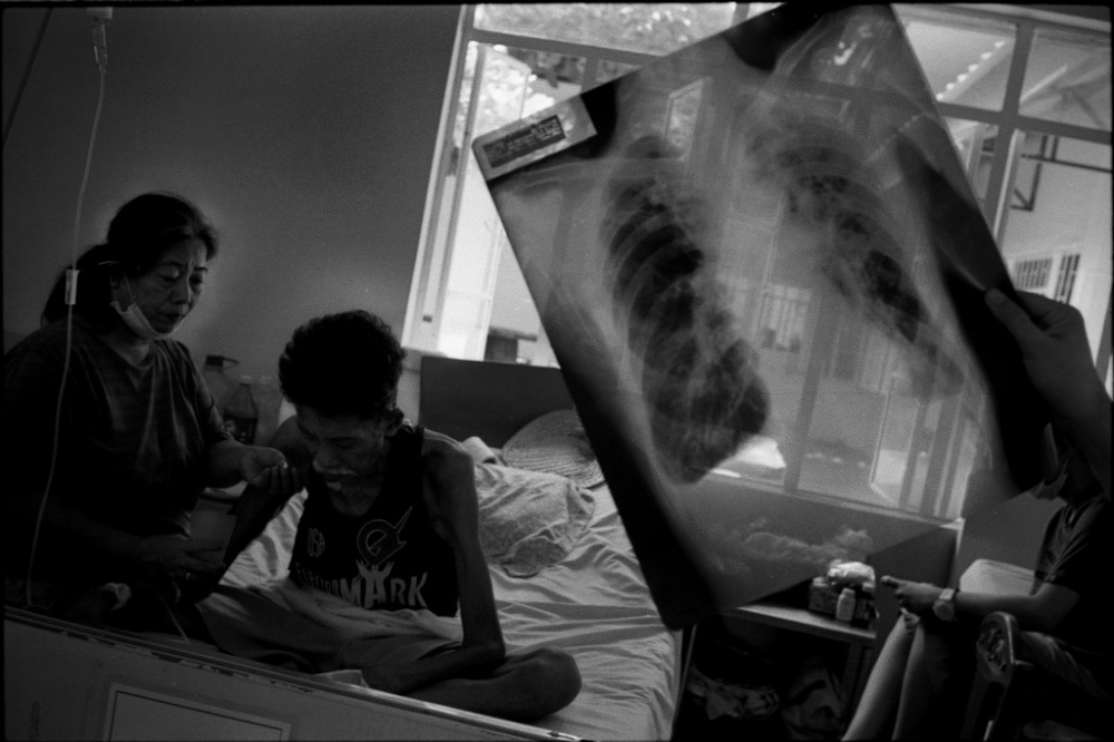 Doctors examined the chest x-ray of a patient with Tuberculosis.