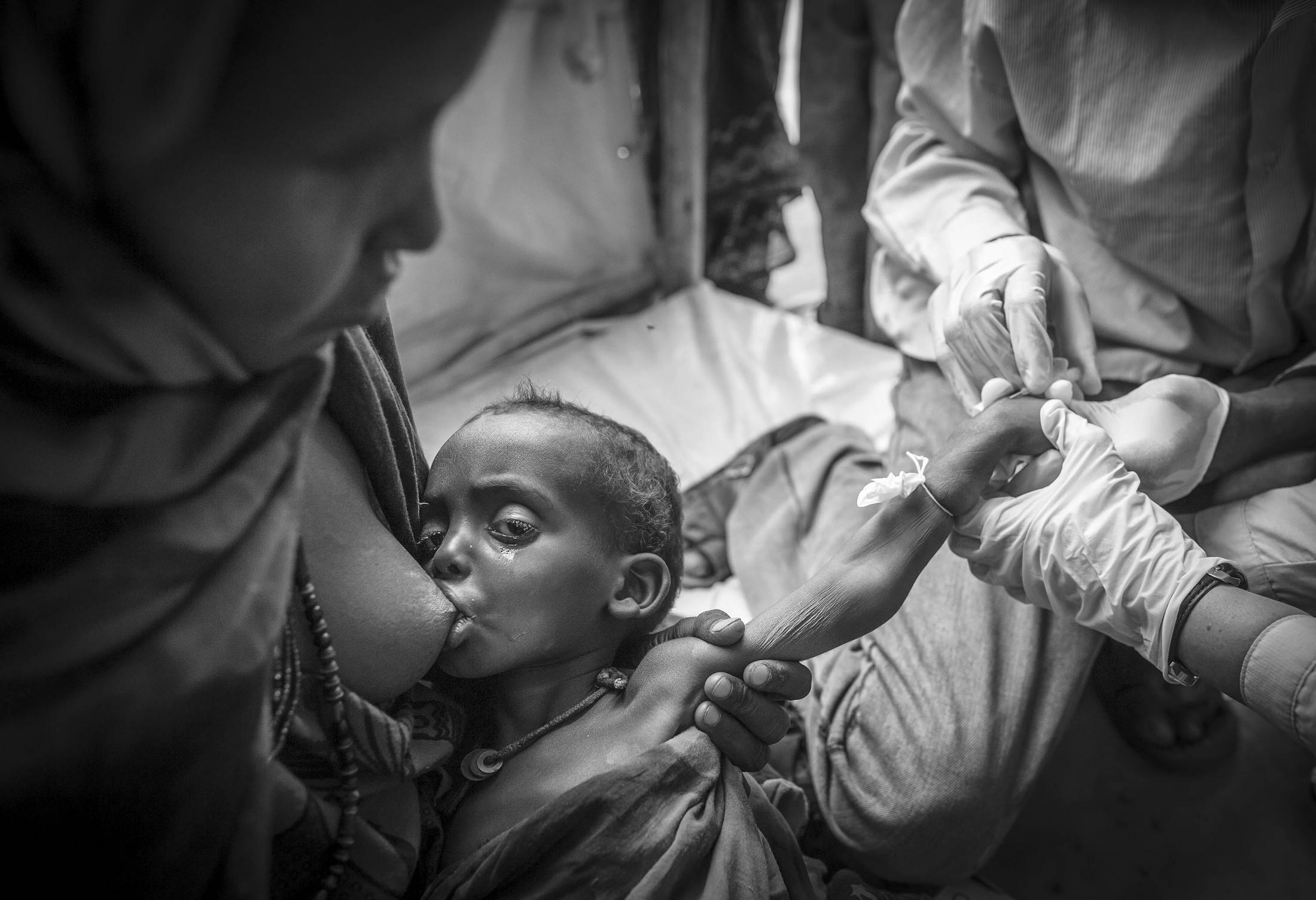 Exodus: Somalia -   2-year-old Ali Abshir is being treated for severe...