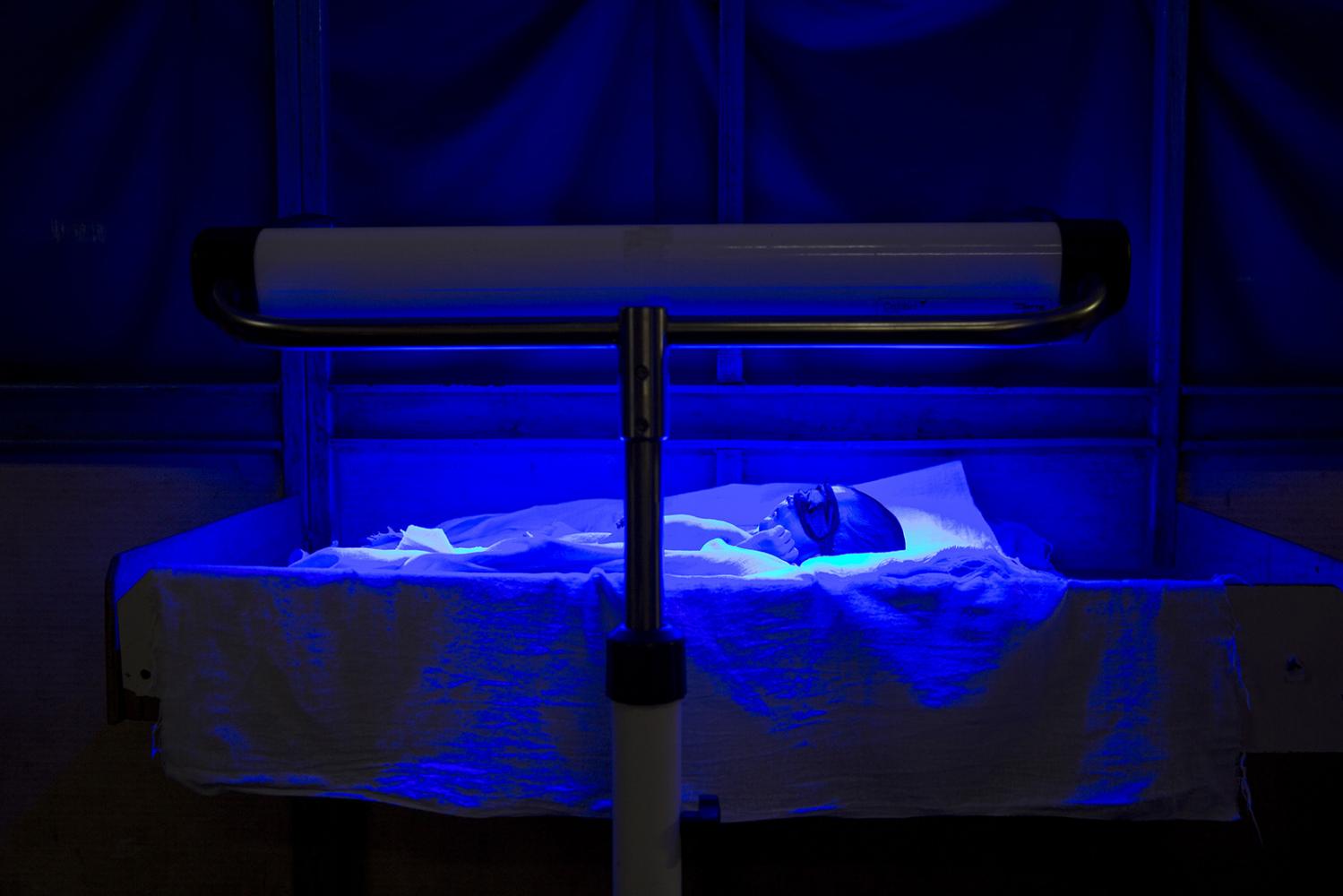 SINGLES - A premature baby receives UV treatment to treat his...