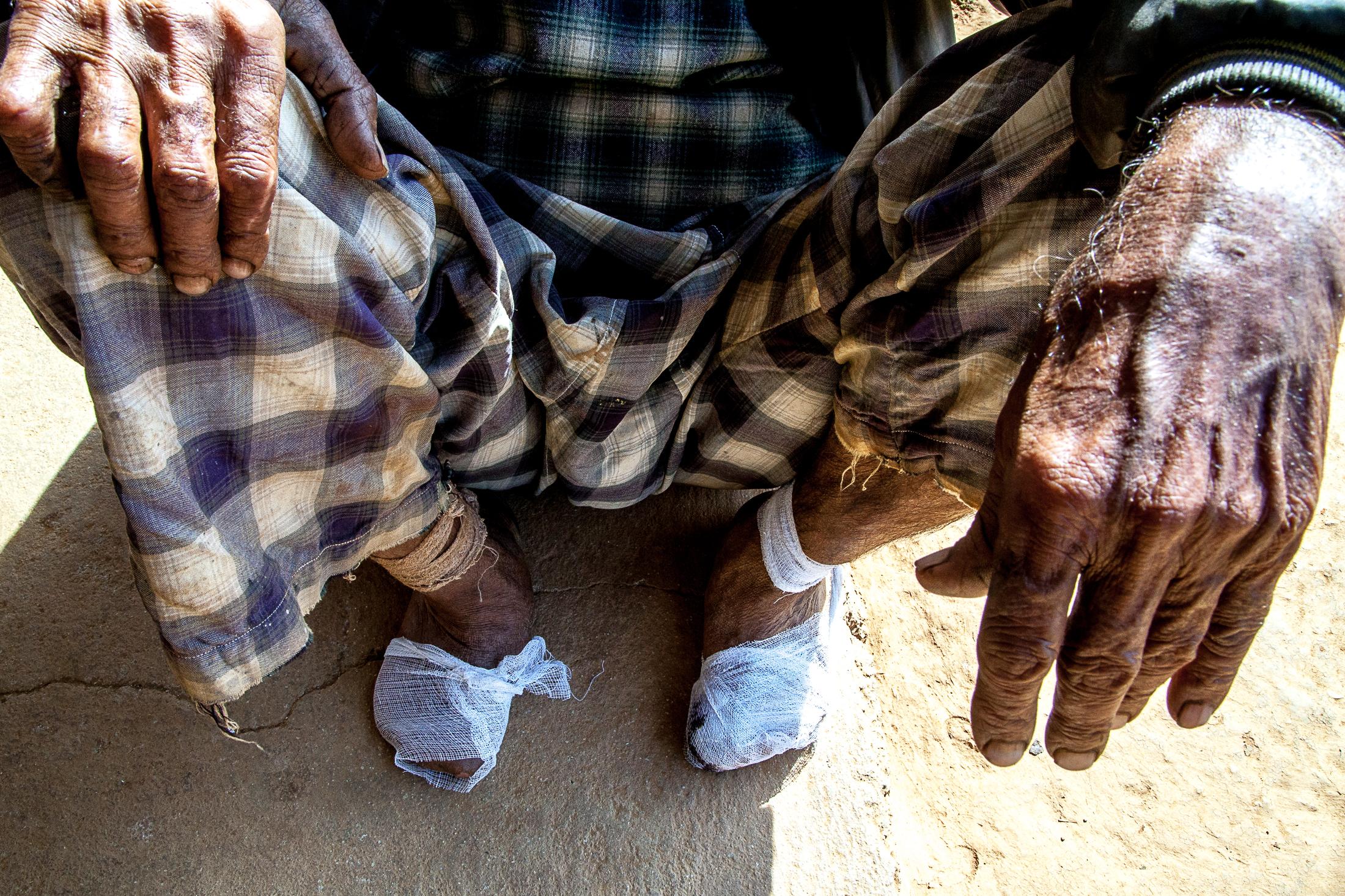 The Forgotten - LELE, NEPAL - JANUARY 24: A man affected by leprosy sits...