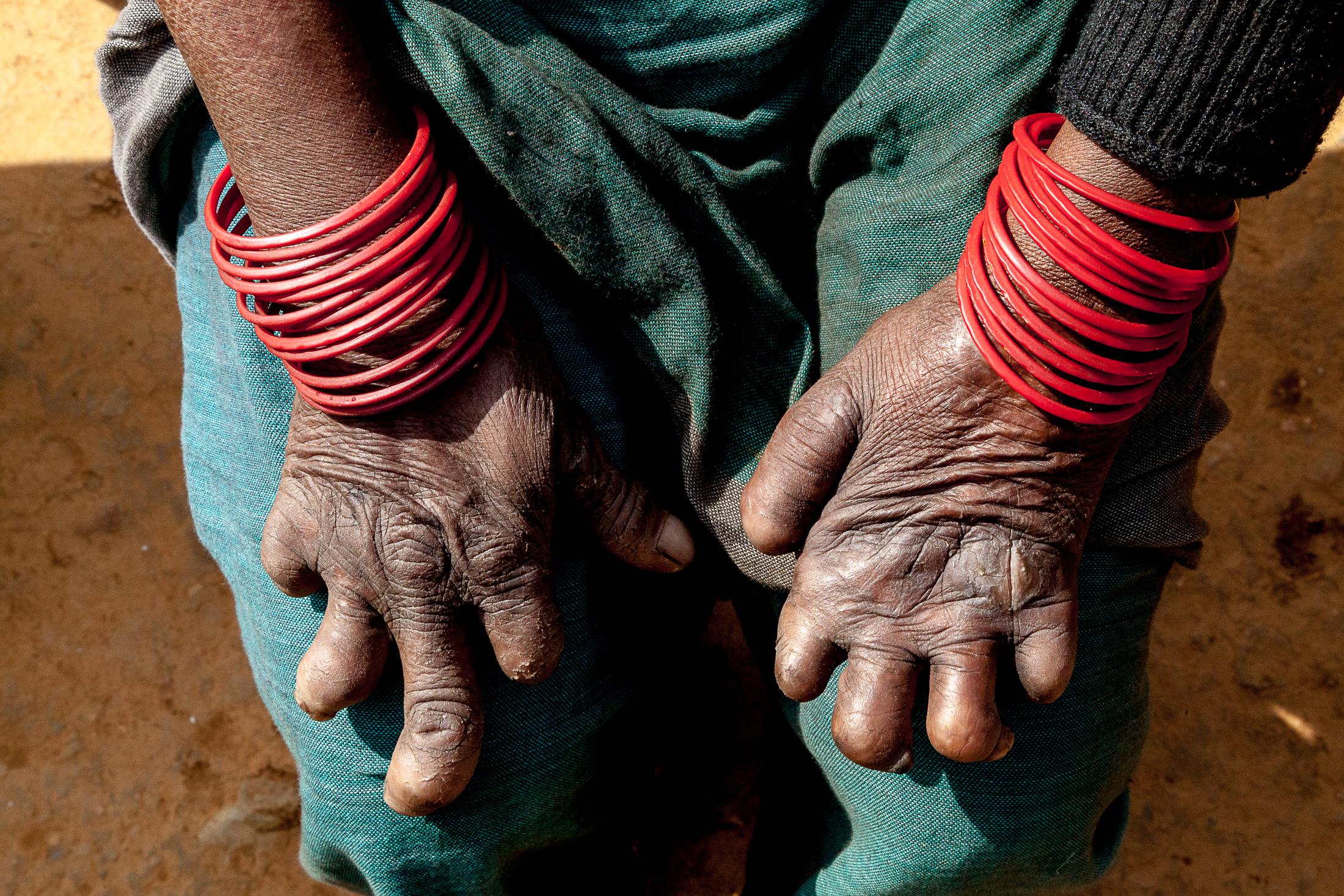 The Forgotten - LELE, NEPAL - JANUARY 24: A woman affected by leprosy...