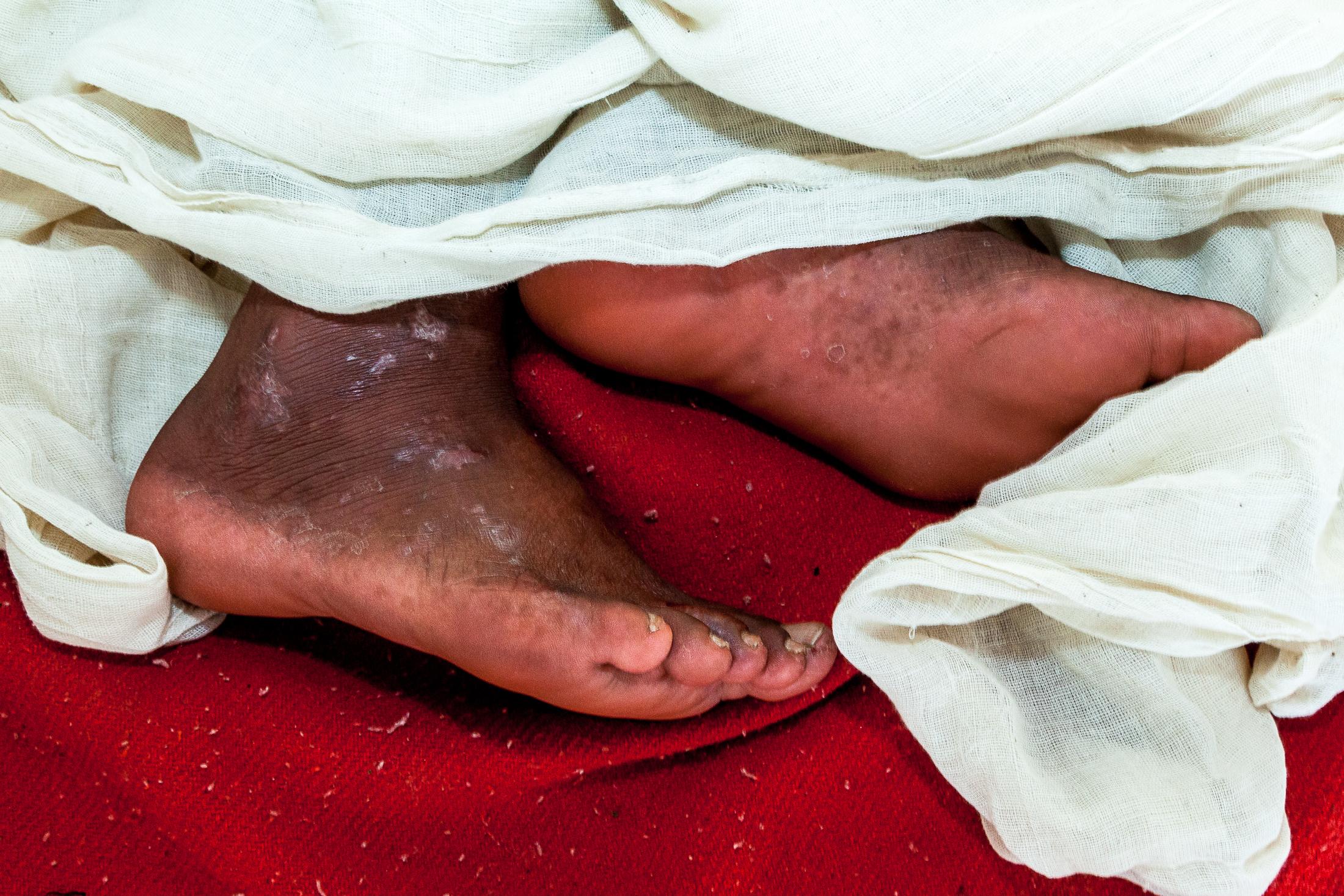 The Forgotten - LELE, NEPAL - JANUARY 24: A man affected by leprosy lays...
