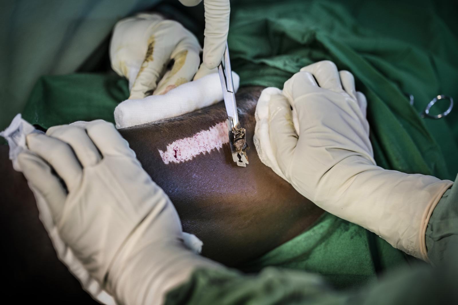 Cutting healthy tissue for grafting onto a skin lesion. 