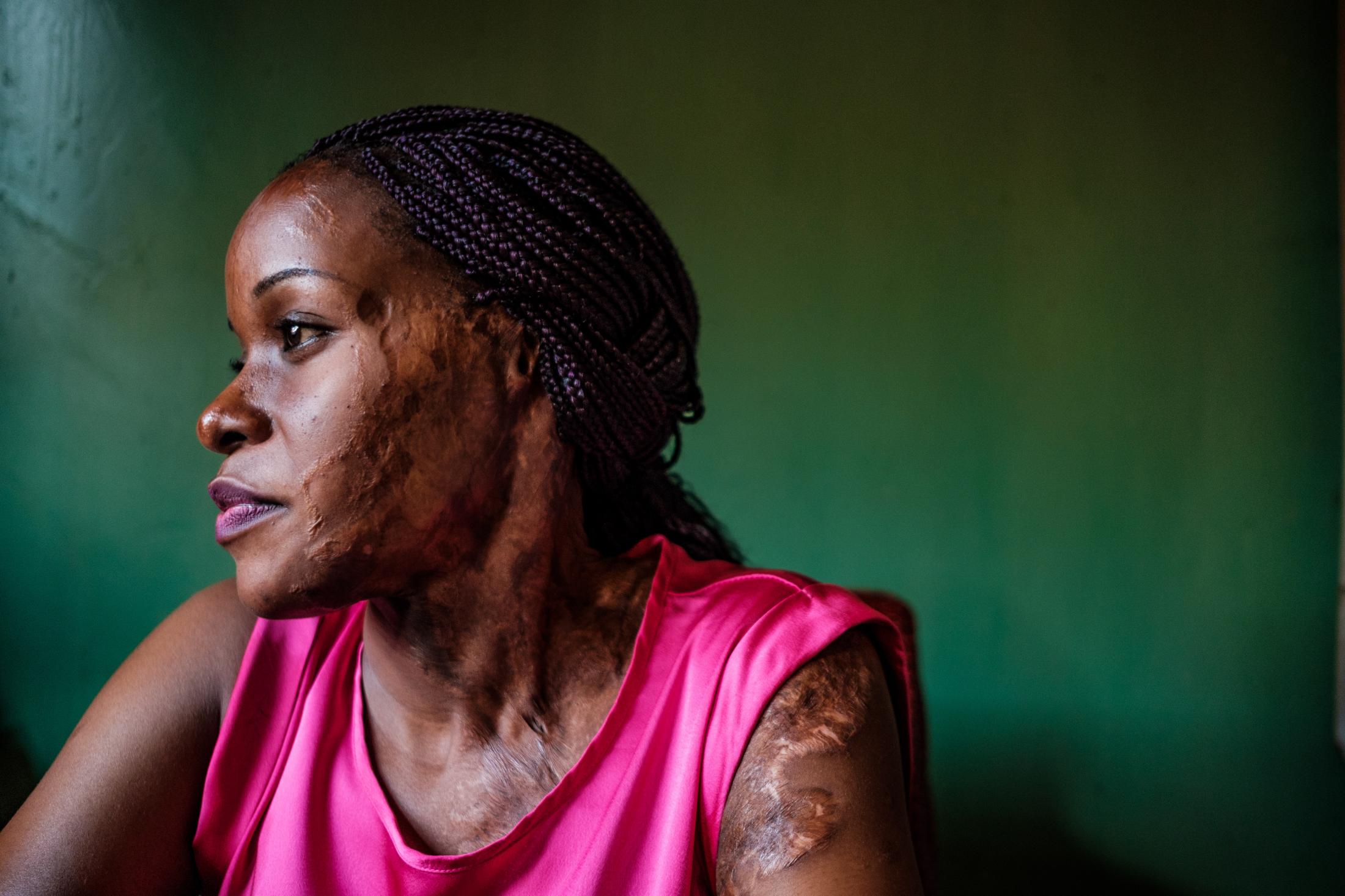 Uganda's acid attack survivors live on
