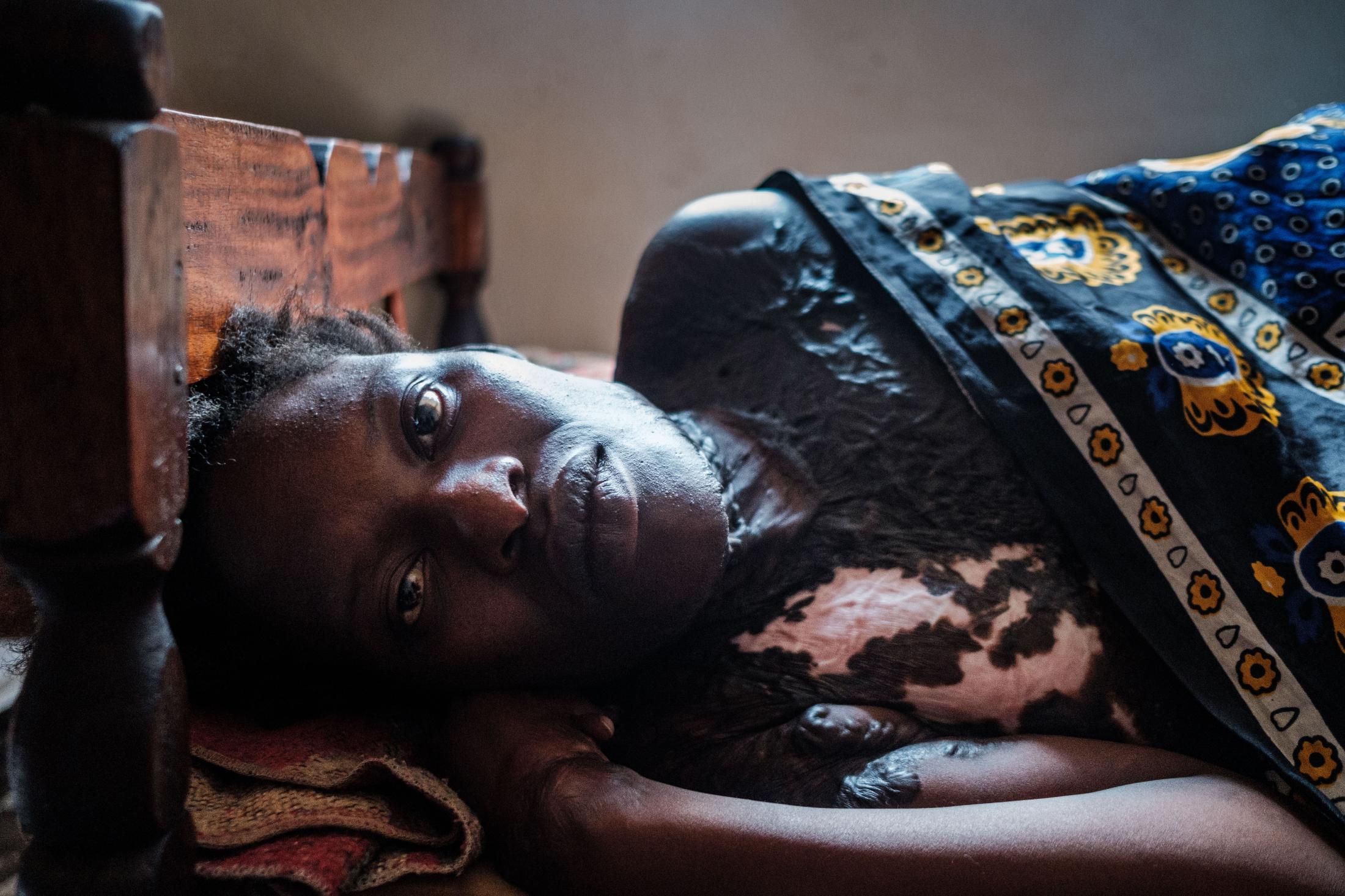 Uganda's acid attack survivors live on