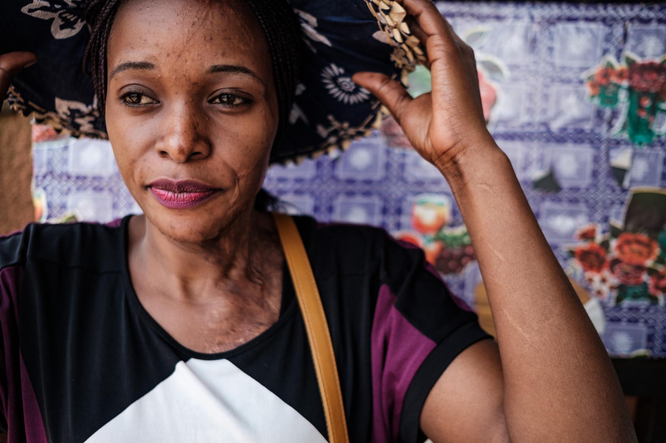 Uganda's acid attack survivors live on
