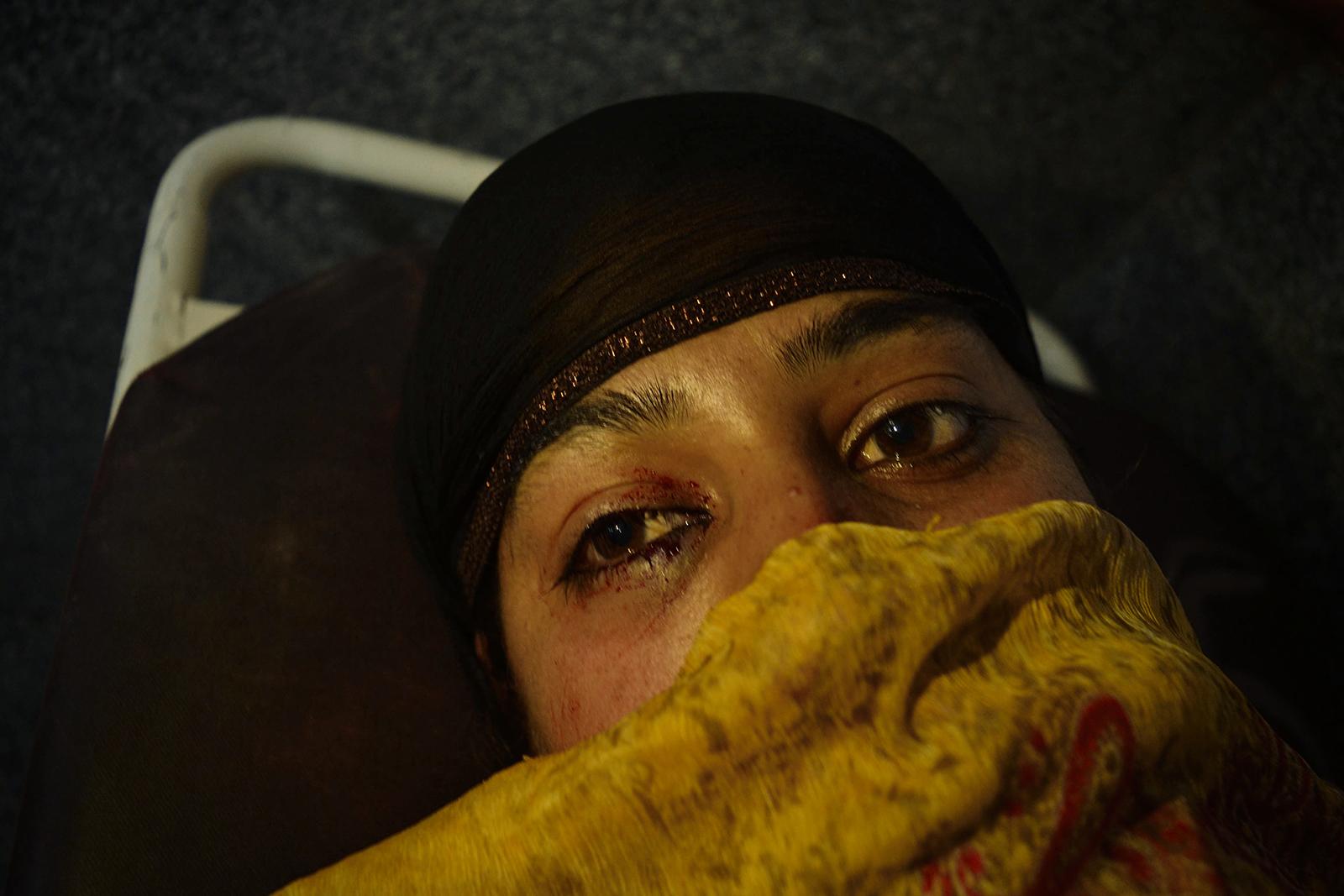 Kashmir-The Never Ending War - . Mysar, 26, looks while reclining on a stretcher at...