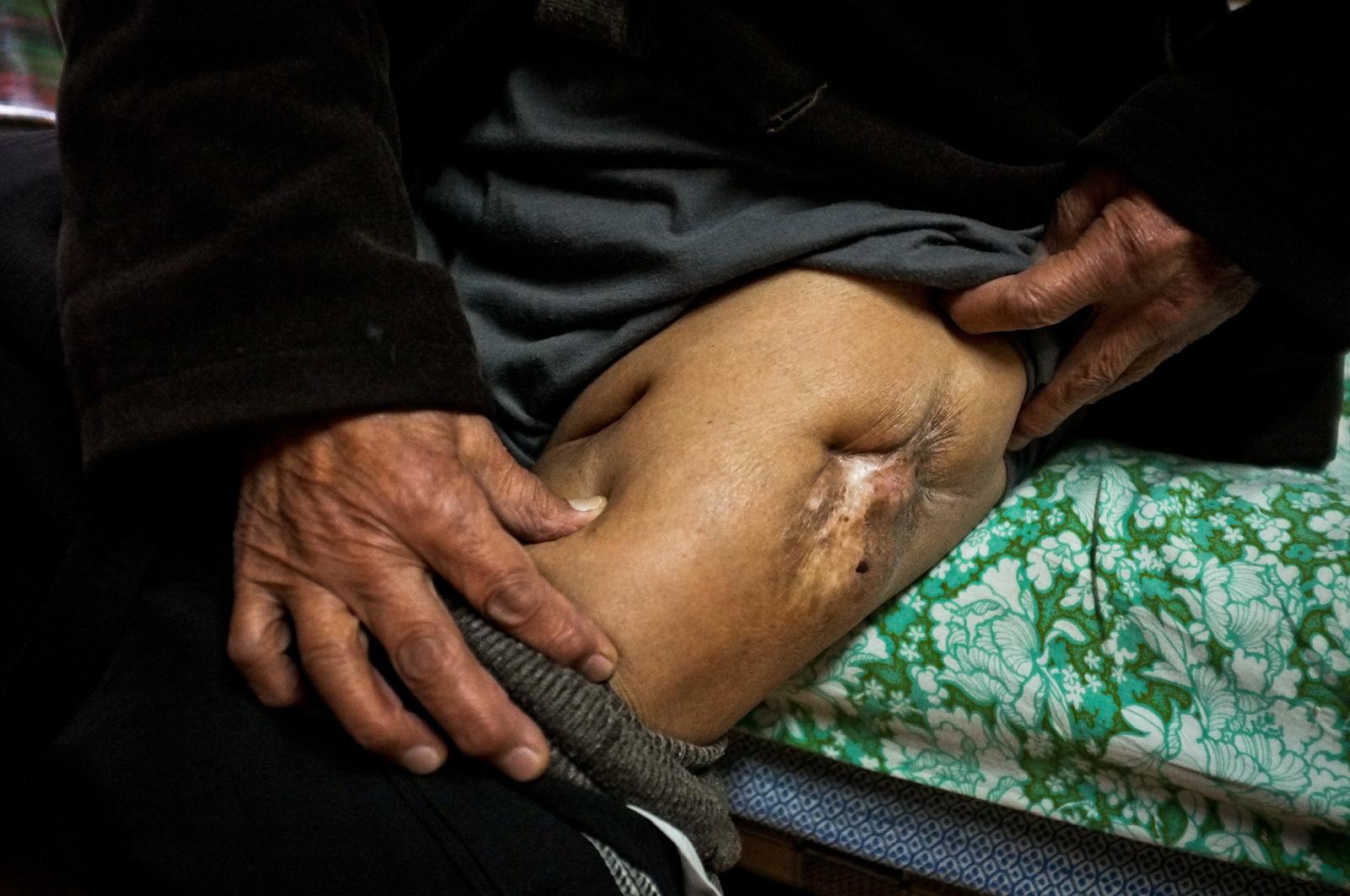 Cao displays his wound where Japanese troops shot him with a dum-dum bullet. It entered the...