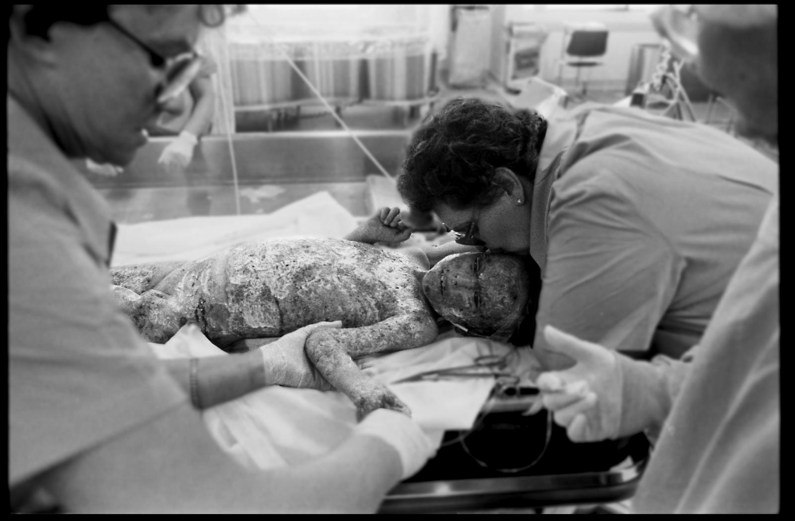 Nurse kisses child burn victim. Burn ICU, St. Mary&#39;s Hospital, Tucson, Arizona USA.