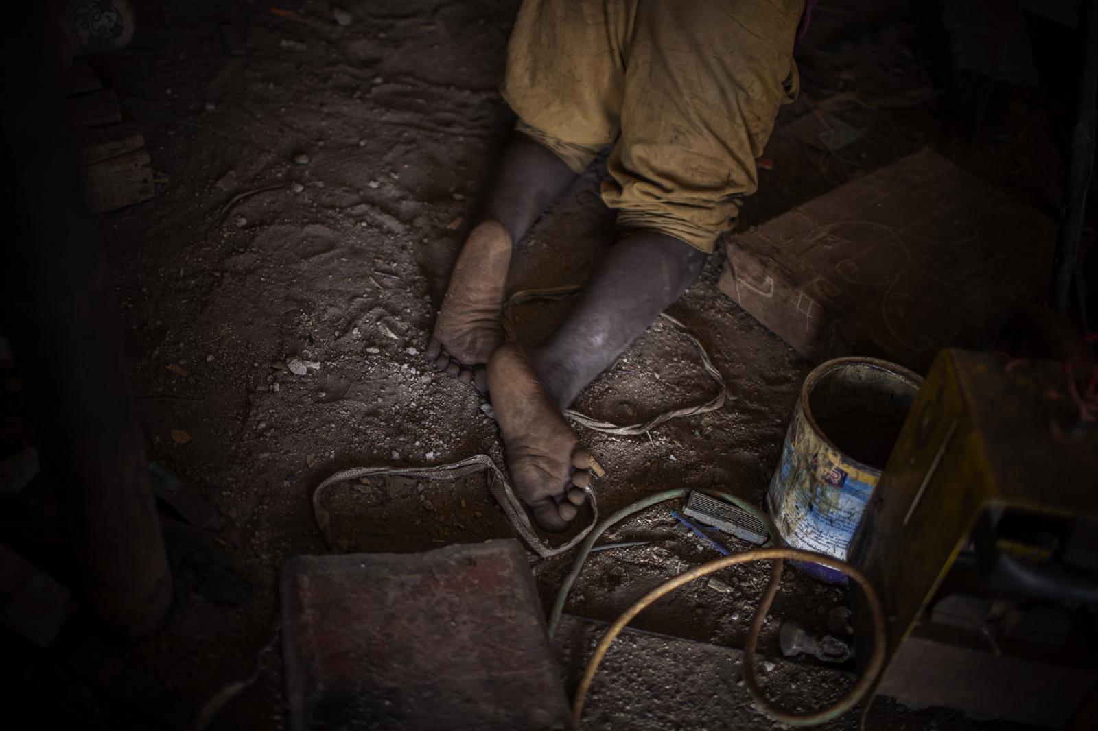Polio Nigeria - The legs of Usman, a polio survivor who works in a...