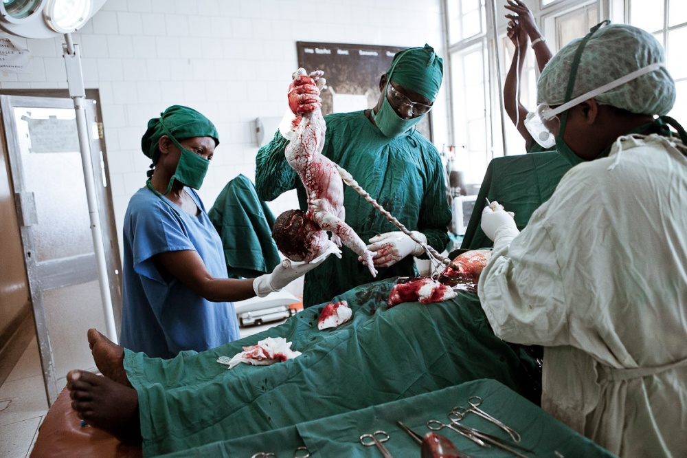  Woman delivering in theatre with a caesarean 