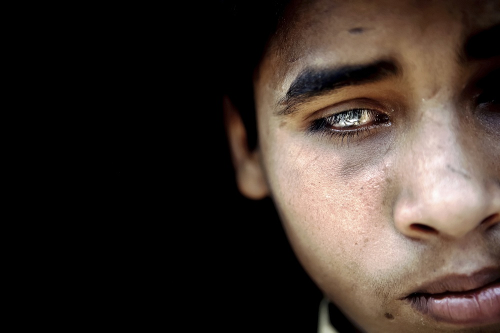 Salman, 13, a boy suffering fro... Bhopal, Madhya Pradesh, India.