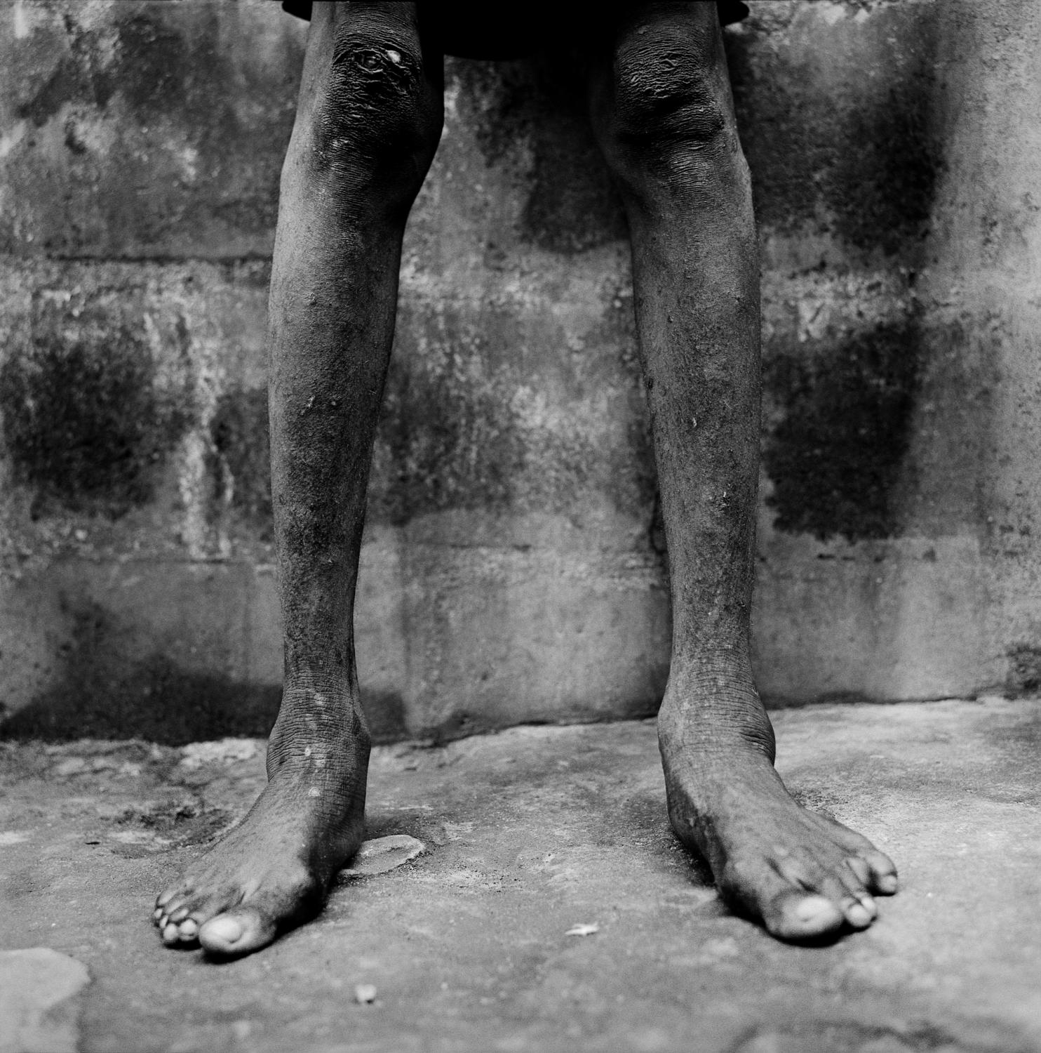 City of rest - SIERRA LEONE Freetown
The legs of a patient at the City...