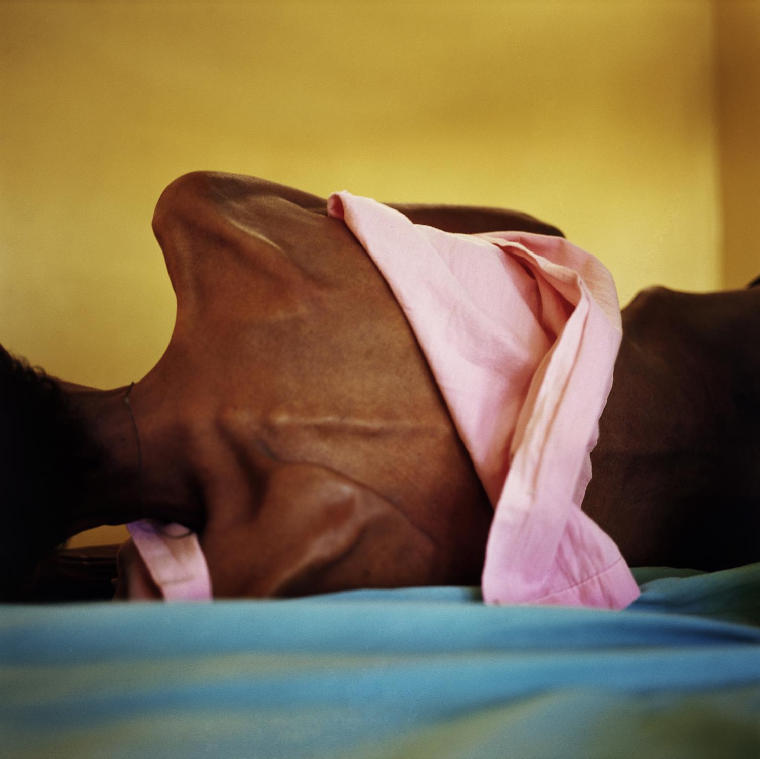 Ethiopia - ETHIOPIA Humera, Tigray An HIV positive patient, who is...